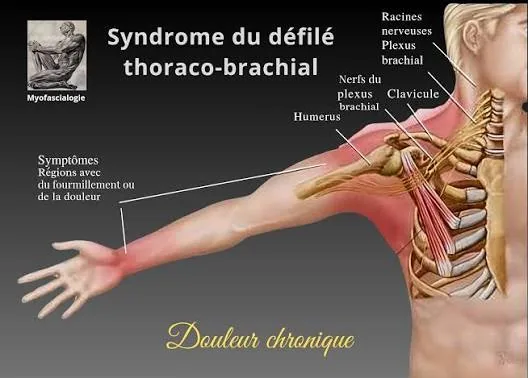 Syndrome du défilé thoraco-brachial