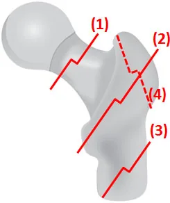 Différents types de fractures du fémur proximal