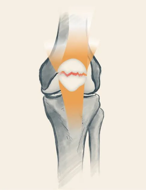 Fracture de la rotule