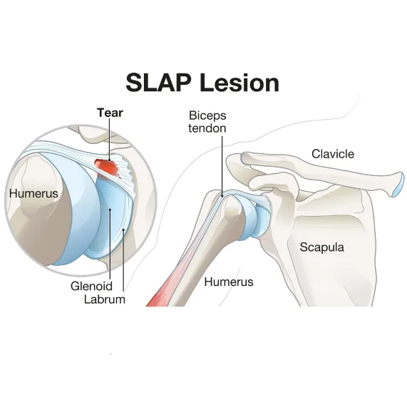 Lésion SLAP du bourrelet glénoïdien supérieur