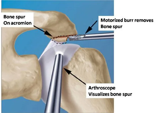 Acromioplastie arthroscopique : résection du bec osseux