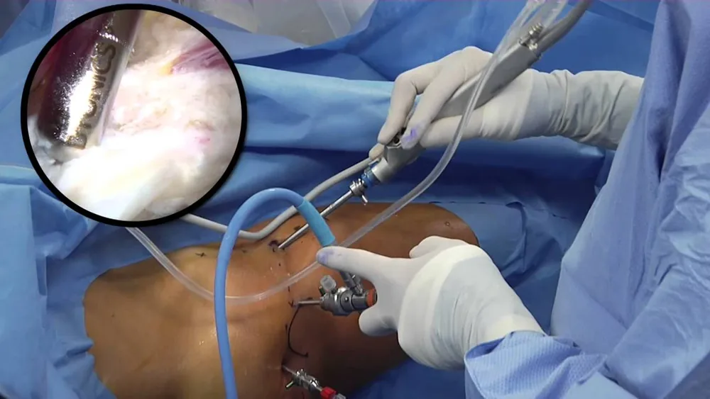 Arthroscopie de hanche au bloc opératoire