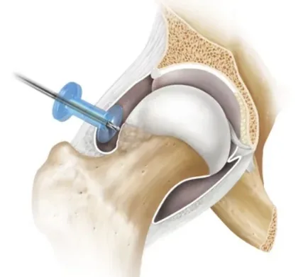 Arthroscopie : résection de la bosse fémorale (CAM)