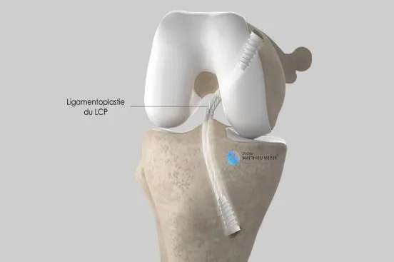 Ligamentoplastie du LCP : greffon fixé par des vis d’interférence