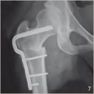 Ostéotomie fémorale de varisation fixée par plaque