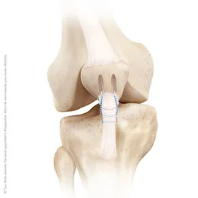 Réparation du tendon rotulien