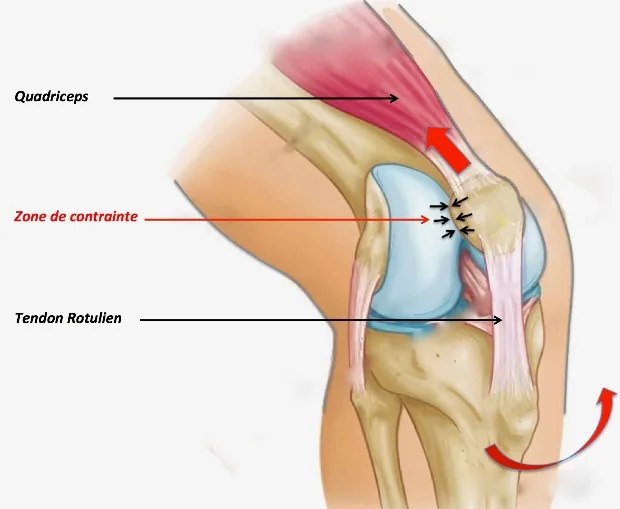 Syndrome fémoro-patellaire : zone de contrainte entre la rotule et le fémur